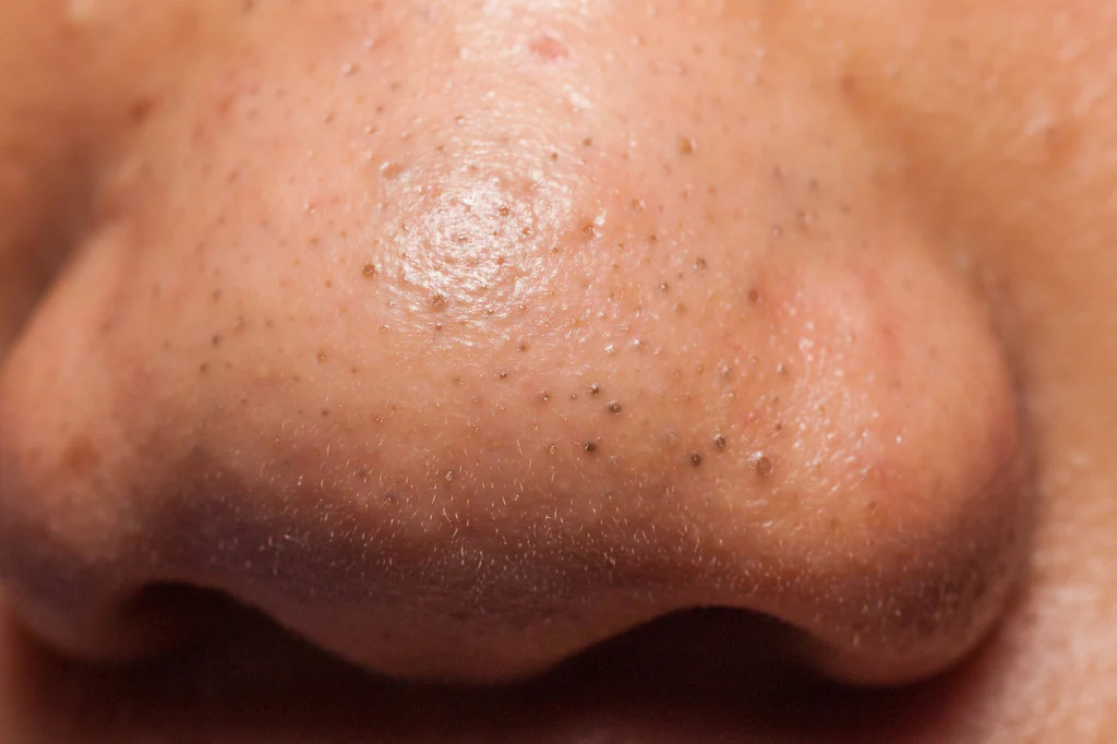 Blackheads: Understanding, Treating, and Preventing Them